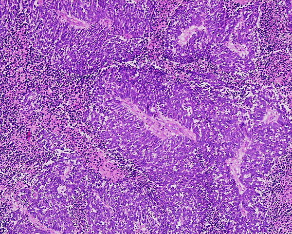 A slide of a cancerous lung