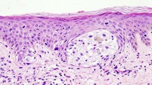 Melanoma in skin biopsy with H&E stain