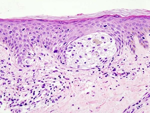 Melanoma in skin biopsy with H&E stain