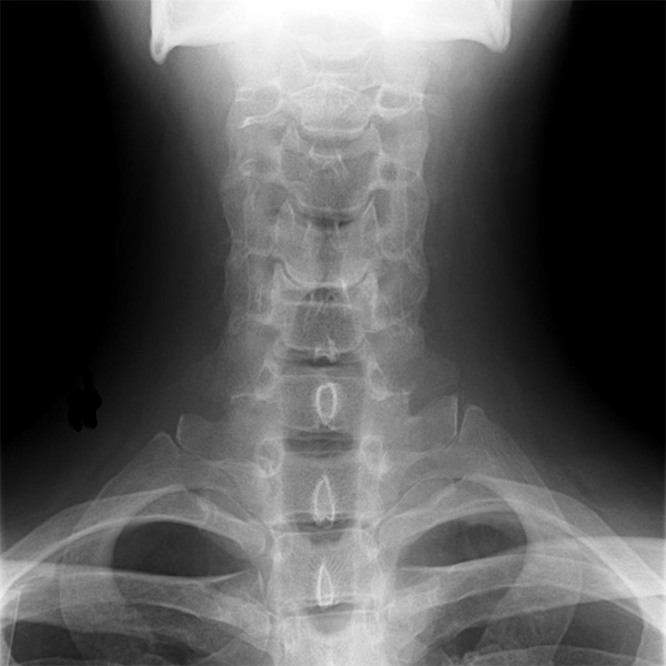 A bone X-ray