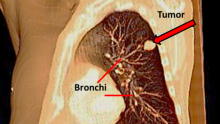 A tumor in the left lung