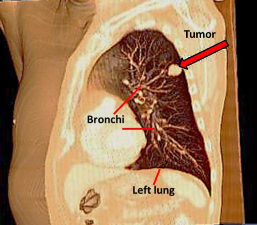A tumor in the left lung