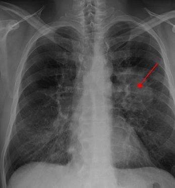 Lung cancer tumor