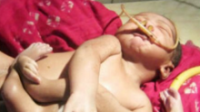 Baby with eight limbs