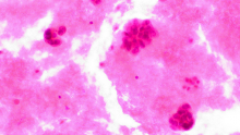 Metastatic Breast Cancer in Pleural Fluid