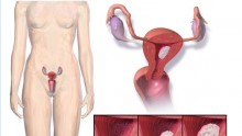 Endometrial cancer