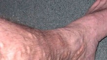 Varicose veins