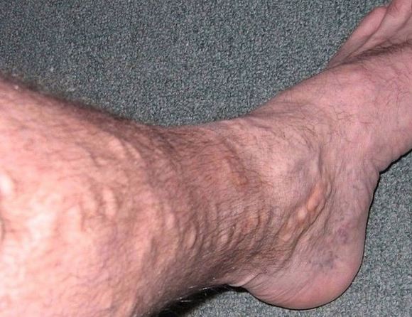 Varicose veins