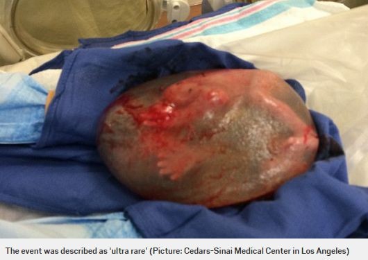 Baby Delivered Fully Encased in a ‘Bubble’