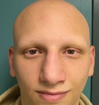 A man with Alopecia universalis