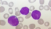 Acute Lymphoblastic Leukemia Cells