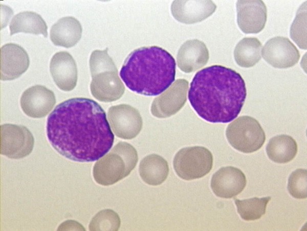 Acute Lymphoblastic Leukemia Cells