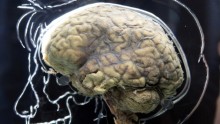 Brain Scan To Detect Multiple Sclerosis And Other Brain Abnormalities