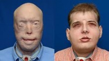 Mississippi Volunteer Firefighter Receives  World's Most Extensive Face Transplant
