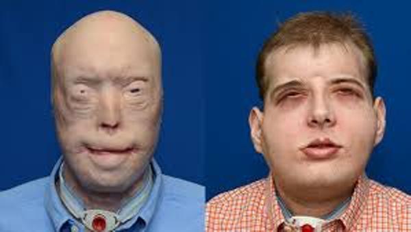 Mississippi Volunteer Firefighter Receives  World's Most Extensive Face Transplant