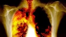More Than 700,000 Chinese To Die From Lung Cancer Yearly By 2020