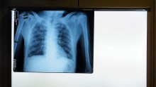 Improved Healthcare will reduce personal cost of TB