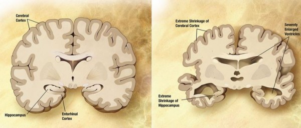 Normal brain and brain with Alzheimer's