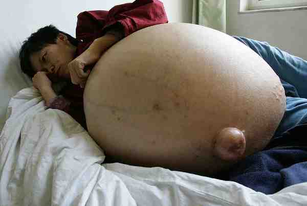 Chinese Woman Suffering From Huge Tumour Undergoes Treatment
