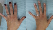 Christa Hendershot's Hand (L-R) Before and After Hand Rejuvenation Surgery